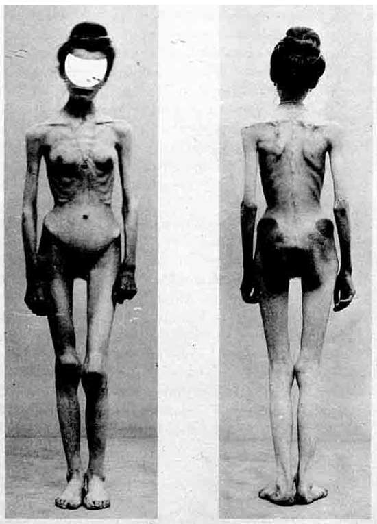 Anorexia Nervosa Magersucht Essstörung