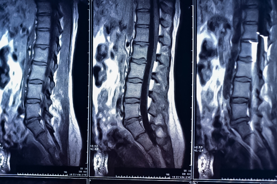 MRT Bandscheibenvorfall Labrum Verletzung Schulter Physiotherapie
